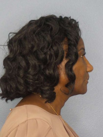 Rhinoplasty Before & After Patient #9893