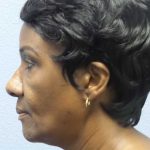 Rhinoplasty Before & After Patient #9893
