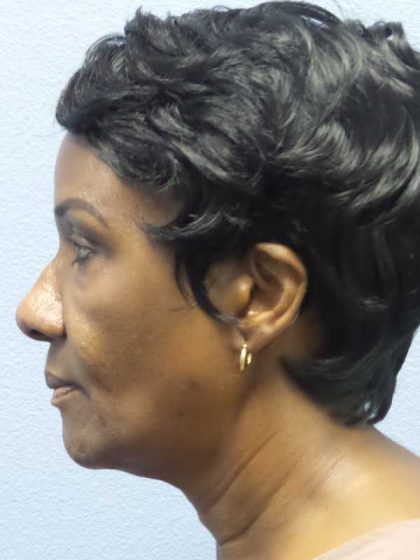 Rhinoplasty Before & After Patient #9893