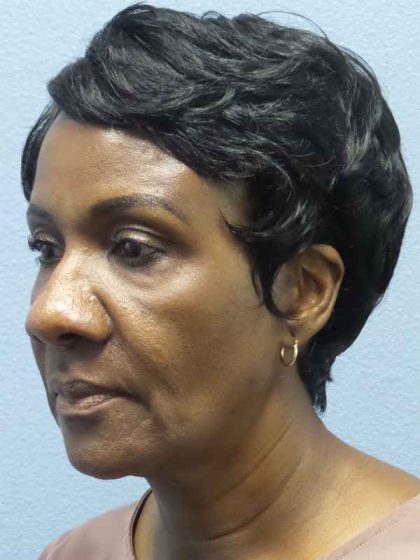 Rhinoplasty Before & After Patient #9893