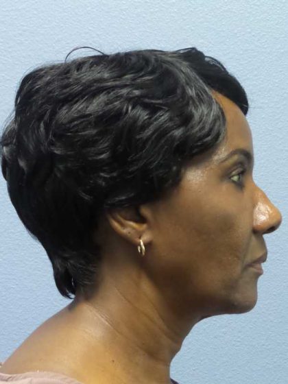 Rhinoplasty Before & After Patient #9893