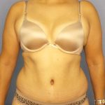 Abdominoplasty Before & After Patient #3283