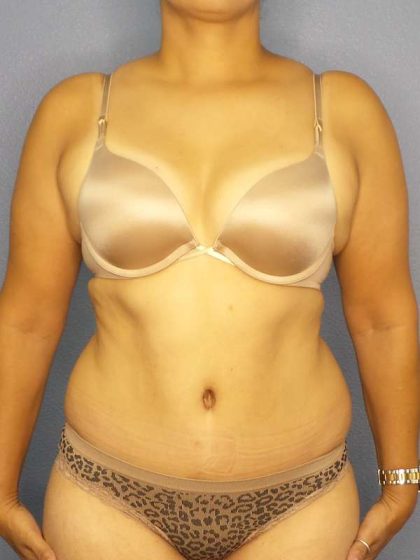 Abdominoplasty Before & After Patient #3283