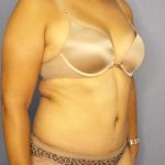 Abdominoplasty Before & After Patient #3283