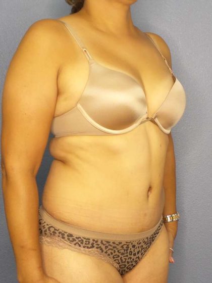 Abdominoplasty Before & After Patient #3283