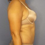 Abdominoplasty Before & After Patient #3283