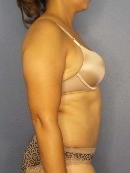 Abdominoplasty Before & After Patient #3283