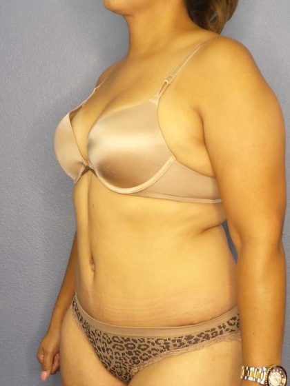 Abdominoplasty Before & After Patient #3283