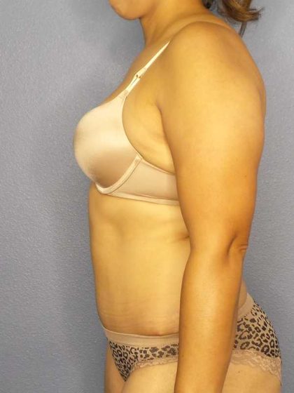 Abdominoplasty Before & After Patient #3283