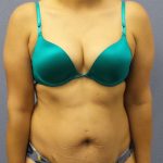 Abdominoplasty Before & After Patient #3283