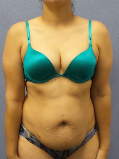 Abdominoplasty Before & After Patient #3283