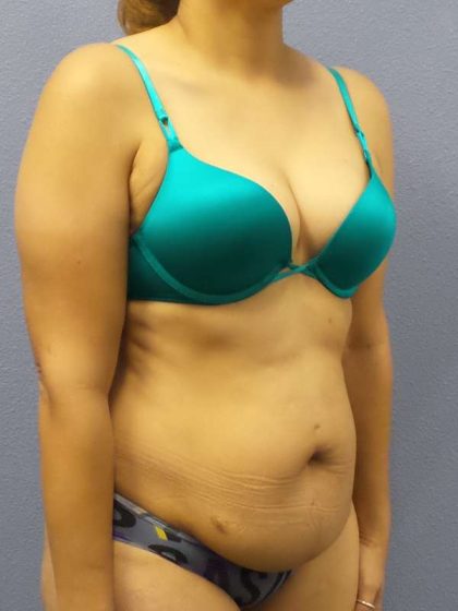 Abdominoplasty Before & After Patient #3283