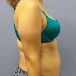 Abdominoplasty Before & After Patient #3283