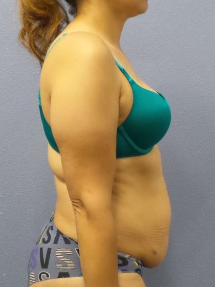Abdominoplasty Before & After Patient #3283