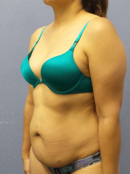 Abdominoplasty Before & After Patient #3283