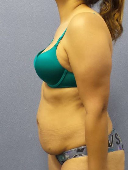 Abdominoplasty Before & After Patient #3283