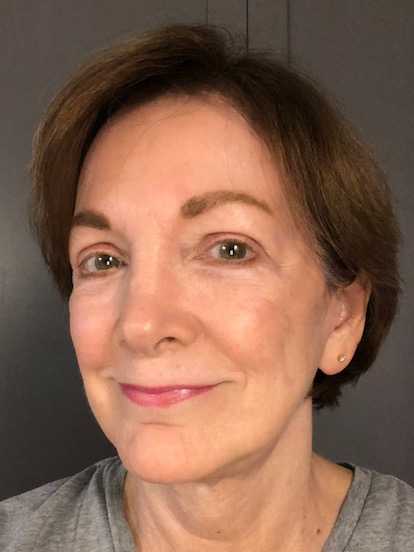 Facelift Before & After Patient #11705