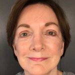 Facelift Before & After Patient #11705