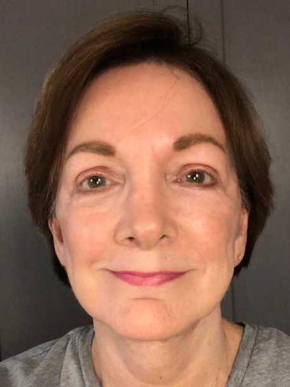 Facelift Before & After Patient #11705