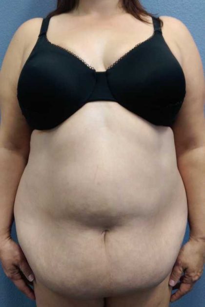 Abdominoplasty Before & After Patient #11131