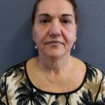 Facelift Before & After Patient #11831
