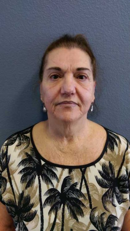 Facelift Before & After Patient #11831