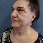 Facelift Before & After Patient #11831