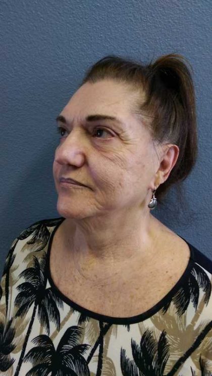 Facelift Before & After Patient #11831