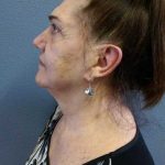 Facelift Before & After Patient #11831
