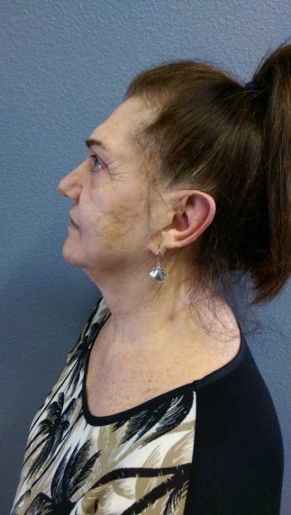 Facelift Before & After Patient #11831