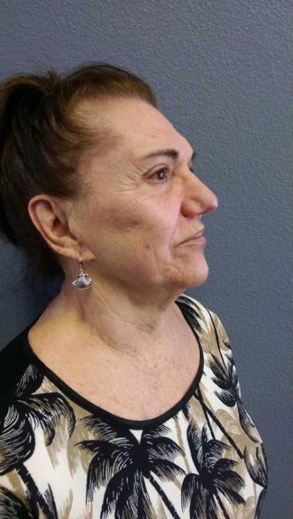 Facelift Before & After Patient #11831