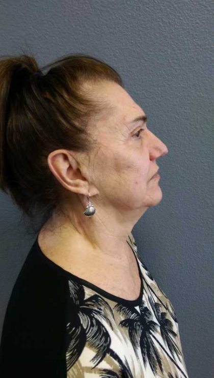 Facelift Before & After Patient #11831