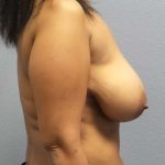 Mastopexy (Breast Lift) Before & After Patient #8362