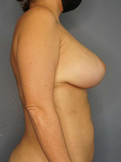 Breast Lift with Implant (Augmentation Mastopexy) Before & After Patient #4520