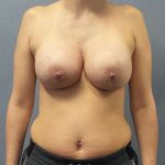 Breast Augmentation Before & After Patient #6728