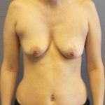 Breast Augmentation Before & After Patient #6728