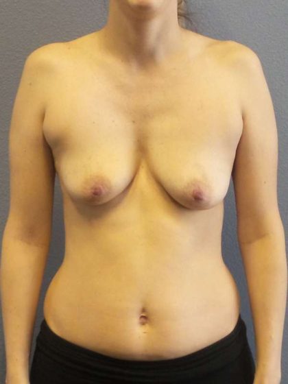 Breast Augmentation Before & After Patient #6728