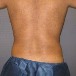 Male Liposuction Before & After Patient #8163