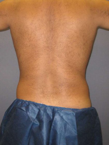 Male Liposuction Before & After Patient #8163