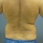 Male Liposuction Before & After Patient #8163