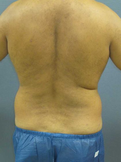 Male Liposuction Before & After Patient #8163