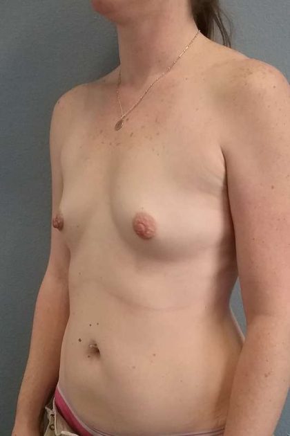 Breast Augmentation Before & After Patient #5122
