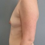 Breast Augmentation Before & After Patient #5122