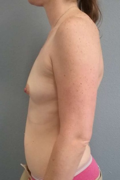 Breast Augmentation Before & After Patient #5122