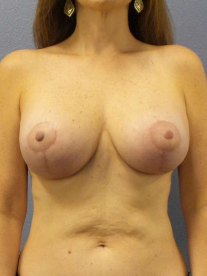 Breast Lift with Implant (Augmentation Mastopexy) Before & After Patient #4365