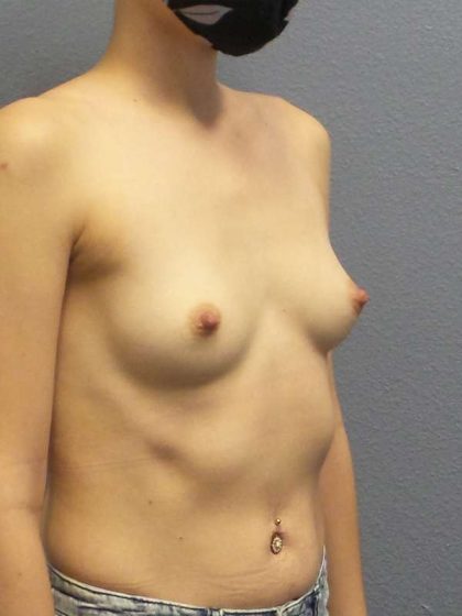 Breast Augmentation Before & After Patient #6664