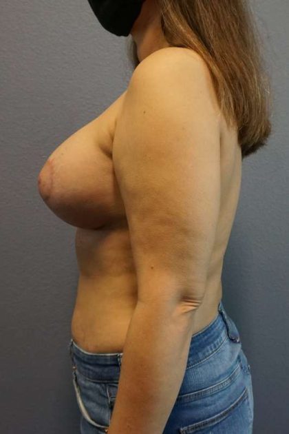 Breast Lift with Implant (Augmentation Mastopexy) Before & After Patient #4162