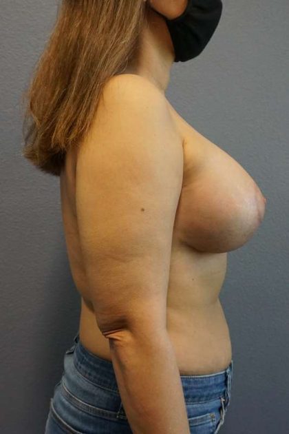 Breast Lift with Implant (Augmentation Mastopexy) Before & After Patient #4162