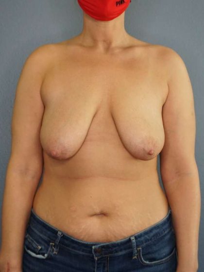 Breast Lift with Implant (Augmentation Mastopexy) Before & After Patient #4162
