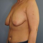 Breast Lift with Implant (Augmentation Mastopexy) Before & After Patient #4162